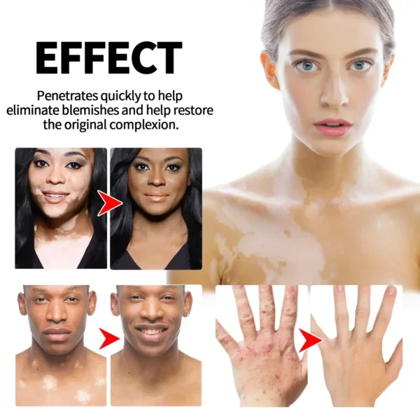 POMMADE DE TRAITEMENT DU VITILIGO (1)