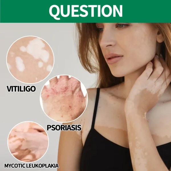 POMMADE DE TRAITEMENT DU VITILIGO (4)