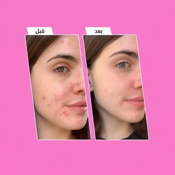 PATCHS VISAGE ANTI au Maroc