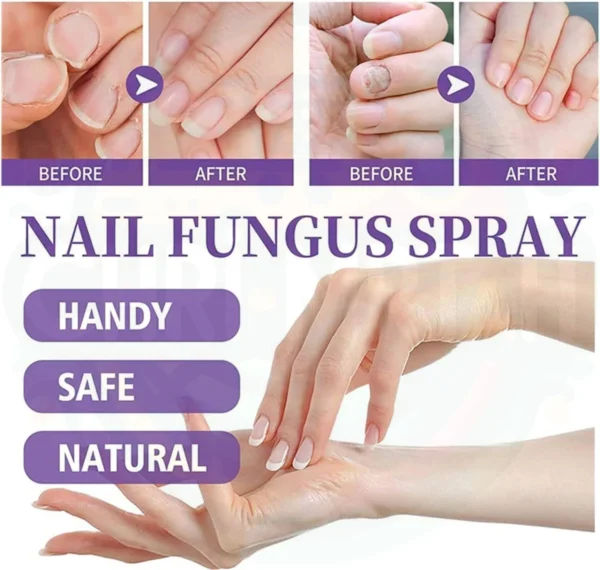 Spray Mycose anti infections Des Ongles au Maroc – Image 11