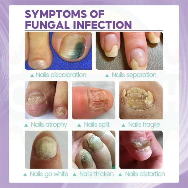 Spray Mycose anti infections Des Ongles au Maroc – Image 12